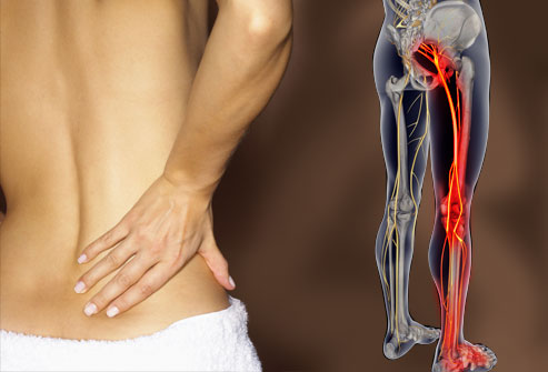 Low back pain and sciatica